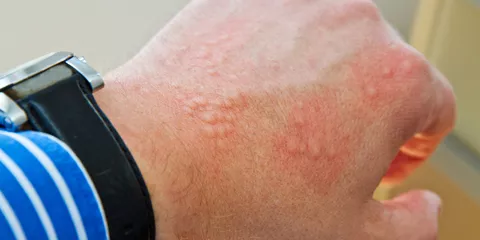 allergie cutanée