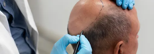 Greffe de cheveux en Tunisie