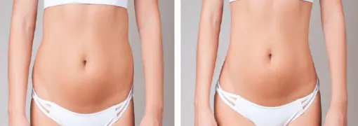 Augmentation des fesses Tunisie